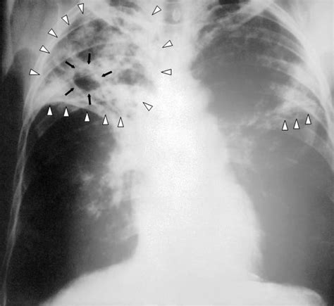 File:Tuberculosis-x-ray-1.jpg - Wikipedia