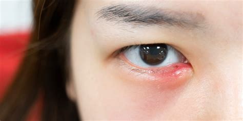 All About Eye Styes-Stye Causes, Treatment and Prevention - Dr. Jiwani ...