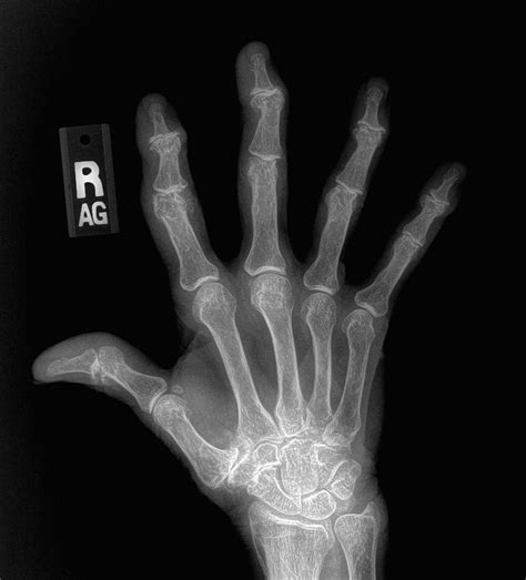 What does hand arthritis look like on x-ray? - John Erickson, MD