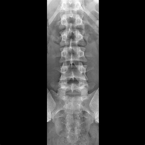 Lumbar Spine, plain film (AP view) [1 of 4]