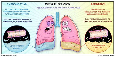 Pleural Effusions: Transudate vs. Exudate BY JORGE MUNIZ, PA-C medcomic ...