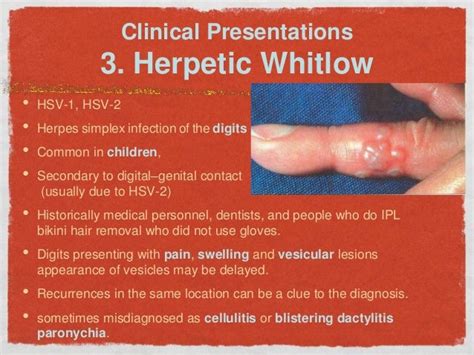 herpes whitlow on hand