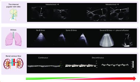 Imaging of Venous, Pulmonary and Renal Congestion by Ultrasound ...