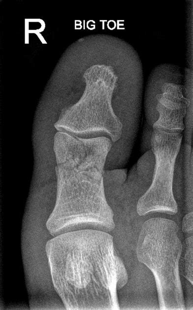 Xray Broken Foot