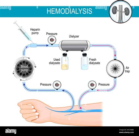 The principle of Hemodialysis machine. Dialysis process. haemodialysis ...