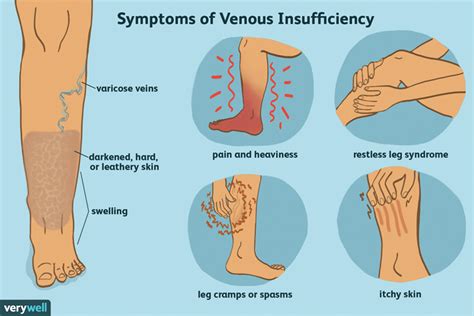 Understanding Chronic Venous Insufficiency - Senior News and Living