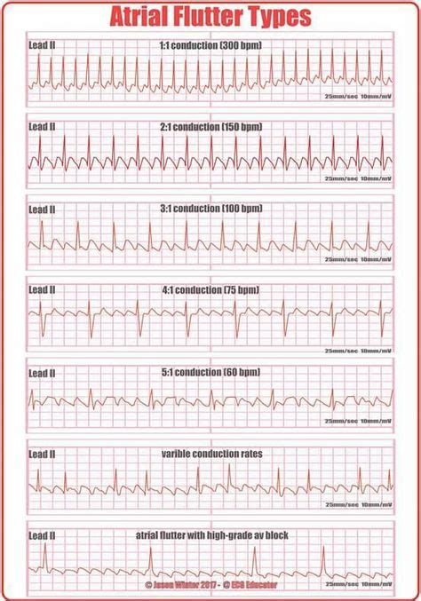 common EKG abnormalities - Google Search | Medical/Nursing School ...