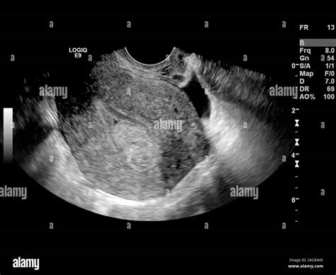 Endometrial Lining Measurements