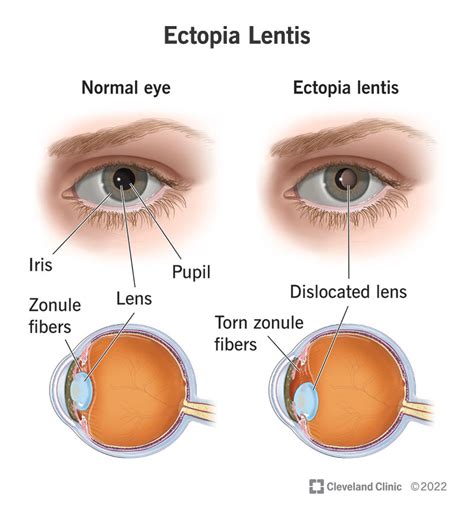 Ectopia Lentis: What It Is, Causes & Symptoms