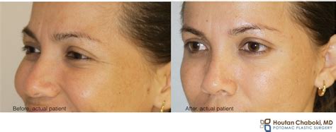 Botox® Brow Lift: A Subtle Lift Without Surgery – Potomac Plastic Surgery