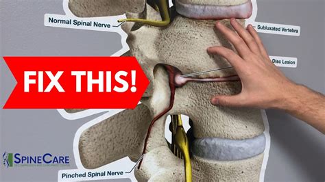 How to Fix a Bulging Disc in Your Lower Back | St. Joseph, MI Chiropractor