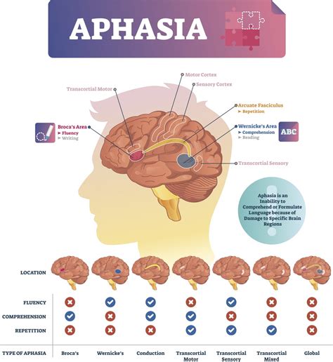 What is aphasia and can rehab slow its effects? | UTSW Medblog