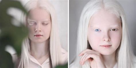 This 11 year old girl has two genetic mutations resulting in amazing beauty