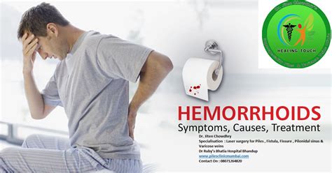 Hemorrhoids : Hemorrhoids are varicose (enlarged a