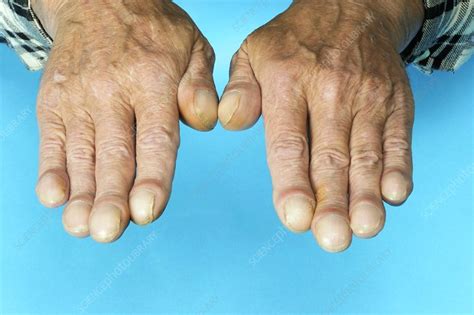 Clubbed fingernails - Stock Image - C010/3261 - Science Photo Library