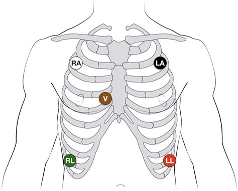 Cardiac Monitor 5 Lead Telemetry Placement