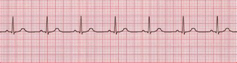 Electrocardiogram (ECG)