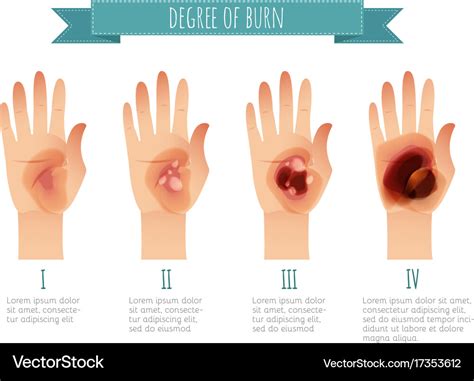 Degree skin burns flat Royalty Free Vector Image