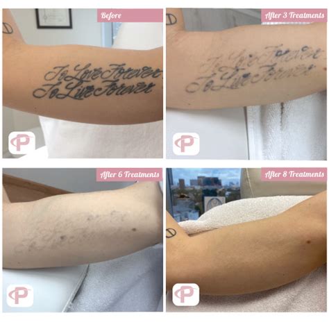 Laser Tattoo Removal Before and After Photos Premium Tattoo Removal