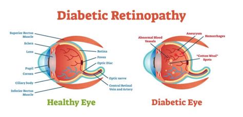 Diabetic Retinopathy: Symptoms, Treatment, Prevention | MyVision.org