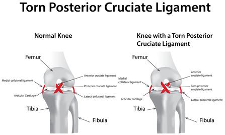 Torn posterior cruciate ligament (PCL) - jointshealth.org