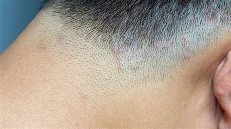 Ringworm Causes | 9 Things to Know About Ringworm