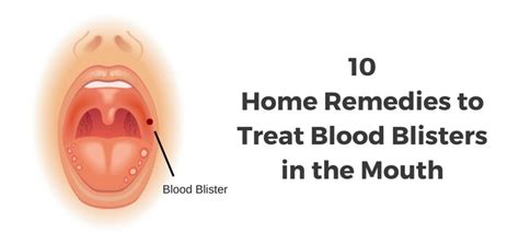 Blood Blisters in Mouth: 10 Causes & Natural Treatments | Daily Health ...