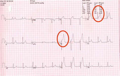 EKG-of-STEMI submited images.