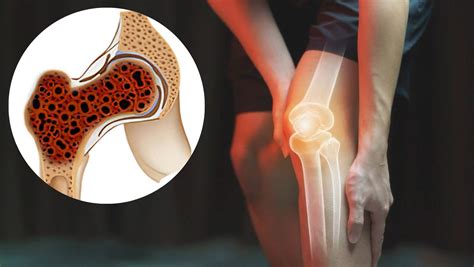 Bone Cancer Symptoms: 7 Warning Signs You Should Never Ignore - Sound ...