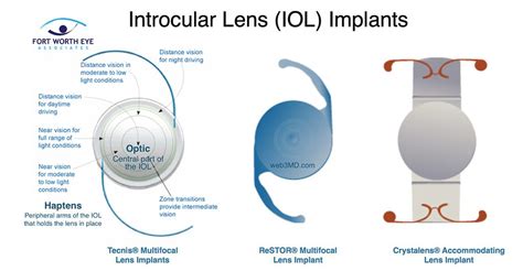 Cataract Surgery Procedure: Safety, Recovery, and Effects