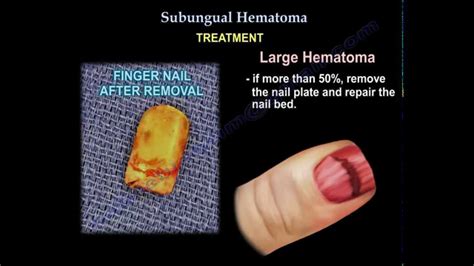 Nail Bed Laceration With Subungual Hematoma - Nail Ftempo