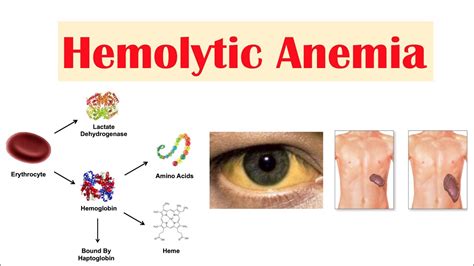 Anemia Rash Symptoms