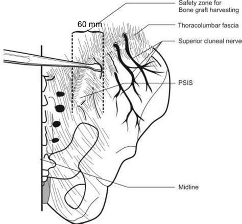 Figure 2 from Anatomical study of the superior cluneal nerve and its ...