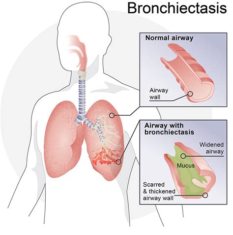 Bronchiectasis : Definition, Causes, Symptoms, Treatment And MCQs for ...