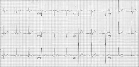 ECG Learning Center - An introduction to clinical electrocardiography