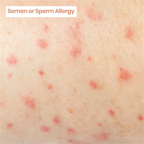 semen allergy | Metromale Clinic & Fertility Center