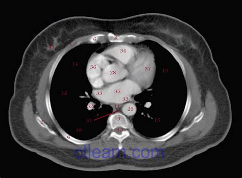 Labeled Chest CT Scan Anatomy