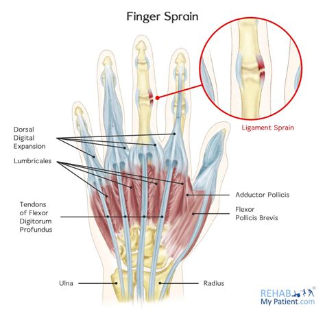 Finger Sprain | Rehab My Patient