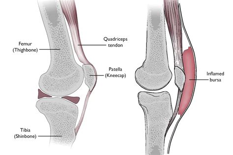 Prepatellar (Kneecap) Bursitis - OrthoInfo - AAOS