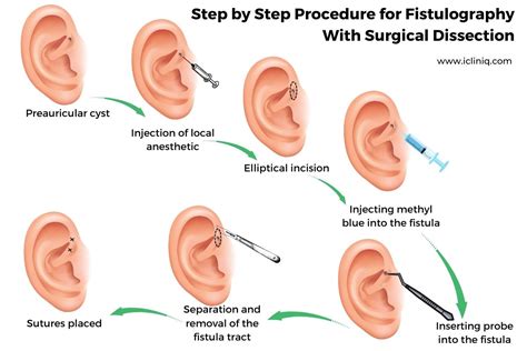 What Is the Treatment for Preauricular Cyst?