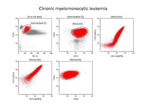 Chronic myelomonocytic leukemia, flow cytometry