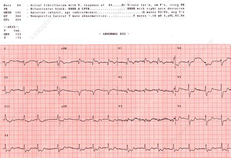 Abnormal EKG - Stock Image - C012/3667 - Science Photo Library