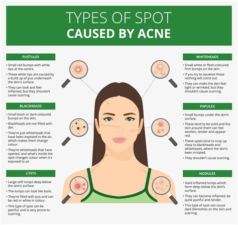 Understanding The Causes Of Acne - Ask The Nurse Expert