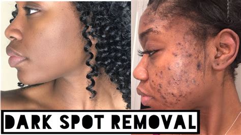 How To Get Rid Of Hyperpigmentation On Black Skin