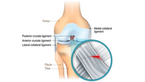 ACL Recovery | Anterior Cruciate Ligament Tear Recovery