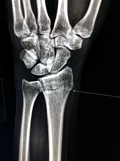 X Ray Broken Bones