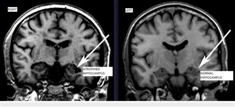 MRI showing atrophy in hippocampus indicated with arrows Arrowhead in ...