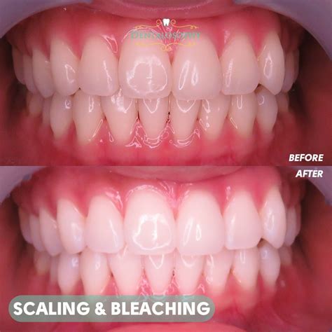 Mengenal Bleaching Gigi dan Jenisnya – Dentalosophy