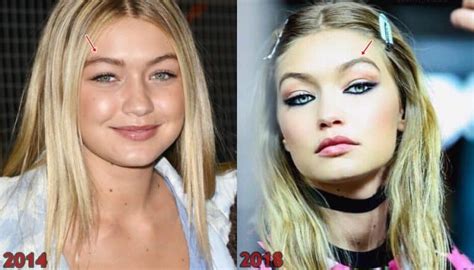 Gigi Hadid Plastic Surgery Before And After Photos