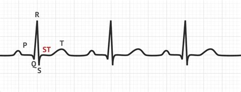 The ST Segment | ECG Basics - MedSchool